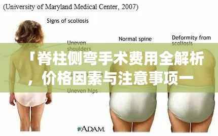 「脊柱侧弯手术费用全解析,价格因素与注意事项一网打尽」